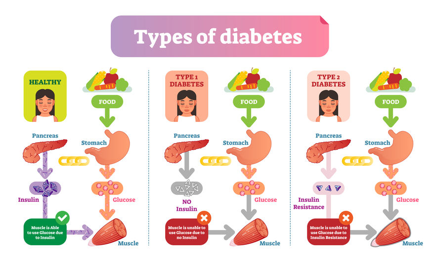 diabetes type 1 and 2 gangrén kezelés a cukorbetegség során